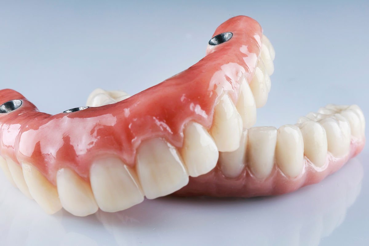Implant-Supported Dentures at NuBite Denture Clinic in Langley