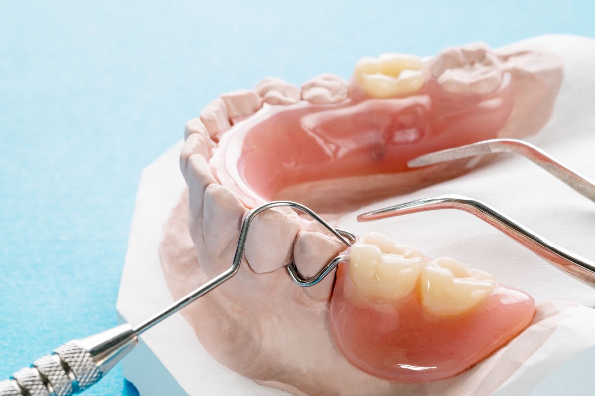 Partial Dentures at NuBite Denture Clinic in Langley